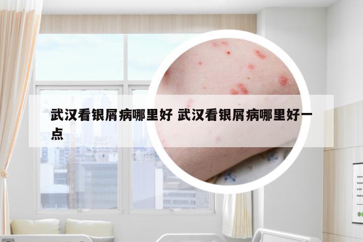 武汉看银屑病哪里好 武汉看银屑病哪里好一点