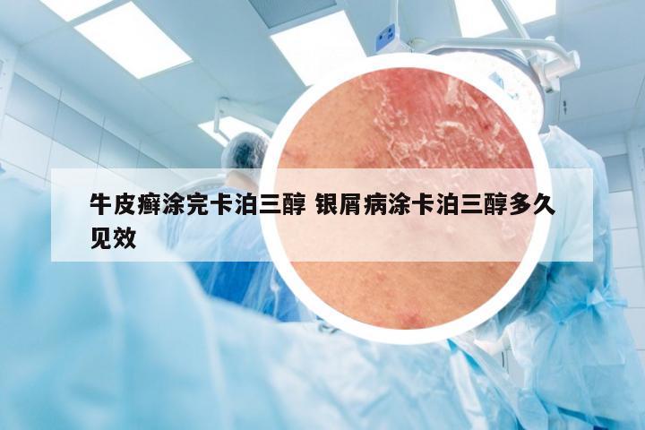 牛皮癣涂完卡泊三醇 银屑病涂卡泊三醇多久见效