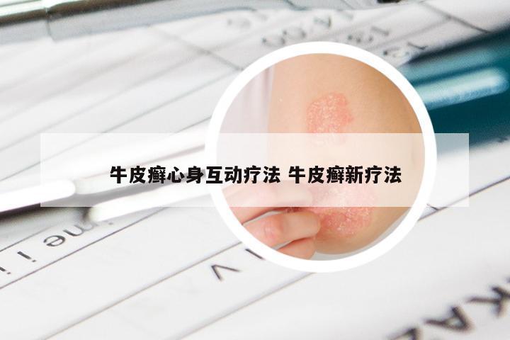 牛皮癣心身互动疗法 牛皮癣新疗法
