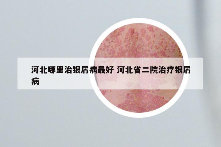 河北哪里治银屑病最好 河北省二院治疗银屑病
