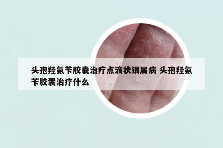 头孢羟氨苄胶囊治疗点滴状银屑病 头孢羟氨苄胶囊治疗什么
