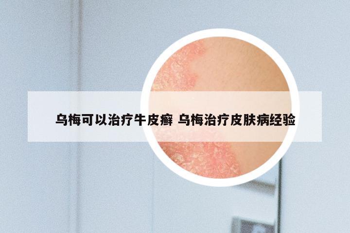 乌梅可以治疗牛皮癣 乌梅治疗皮肤病经验