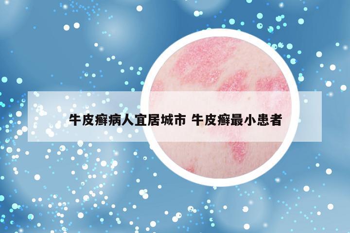 牛皮癣病人宜居城市 牛皮癣最小患者
