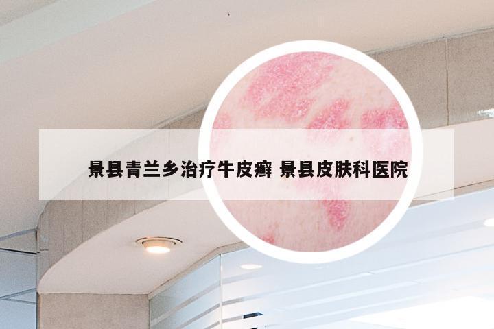 景县青兰乡治疗牛皮癣 景县皮肤科医院