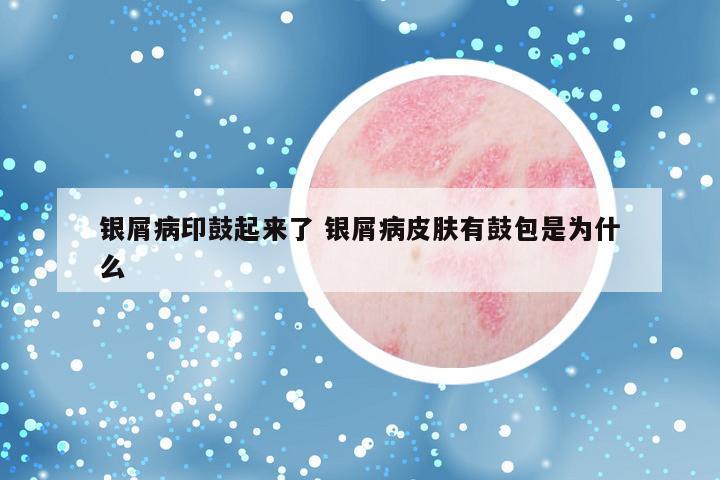 银屑病印鼓起来了 银屑病皮肤有鼓包是为什么