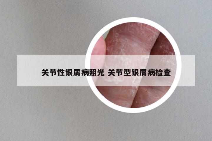 关节性银屑病照光 关节型银屑病检查