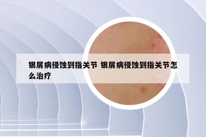 银屑病侵蚀到指关节 银屑病侵蚀到指关节怎么治疗