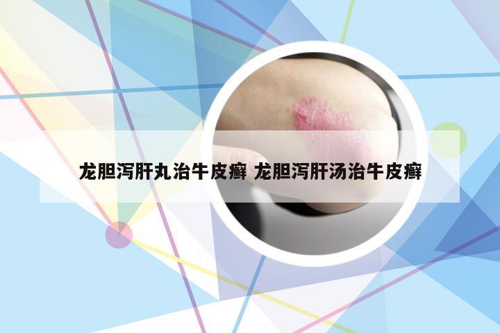 龙胆泻肝丸治牛皮癣 龙胆泻肝汤治牛皮癣