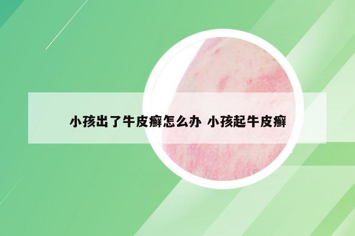 小孩出了牛皮癣怎么办 小孩起牛皮癣