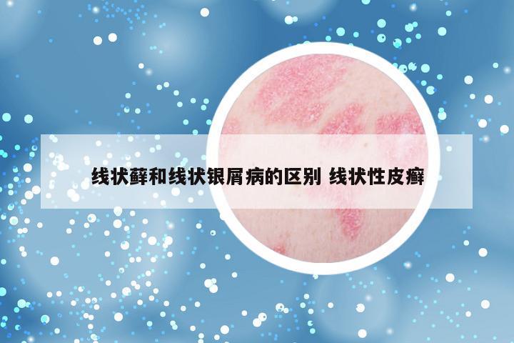 线状藓和线状银屑病的区别 线状性皮癣