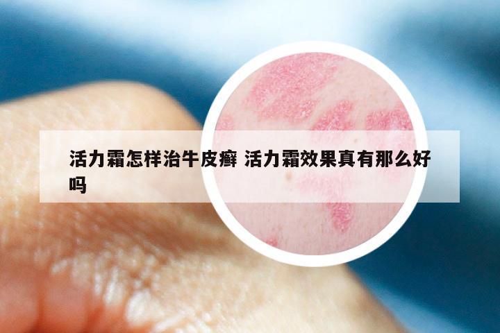 活力霜怎样治牛皮癣 活力霜效果真有那么好吗