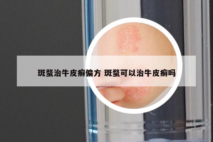 斑蝥治牛皮癣偏方 斑蝥可以治牛皮癣吗