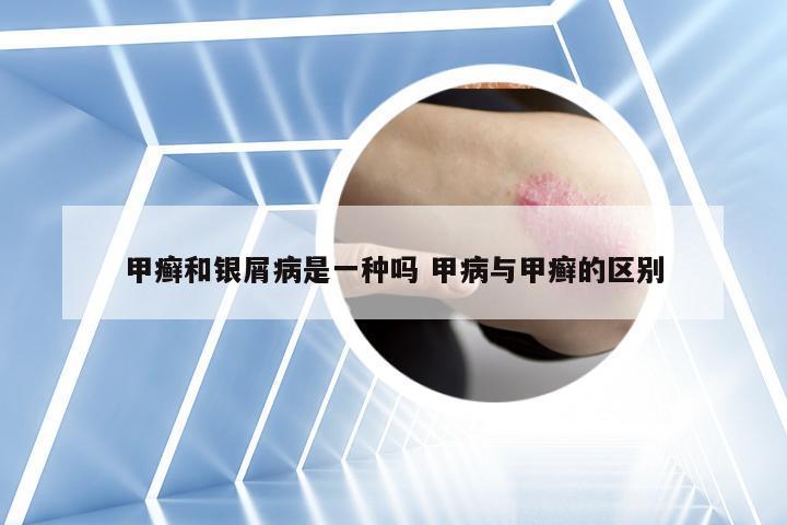 甲癣和银屑病是一种吗 甲病与甲癣的区别