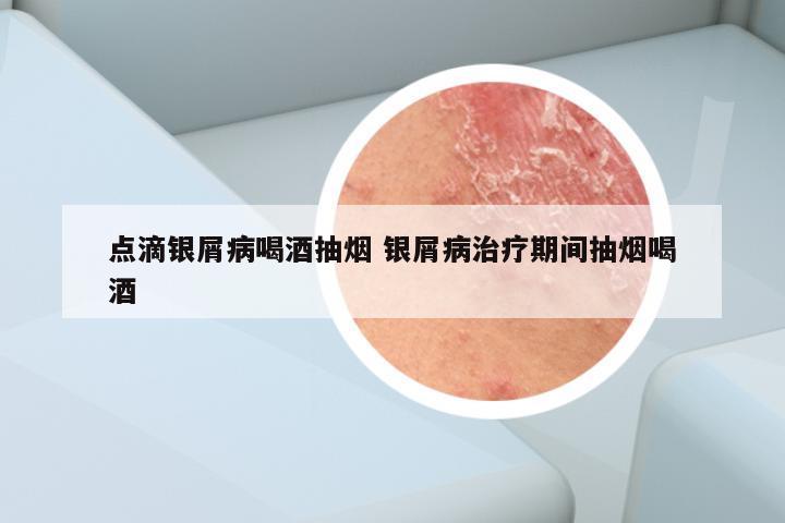 点滴银屑病喝酒抽烟 银屑病治疗期间抽烟喝酒