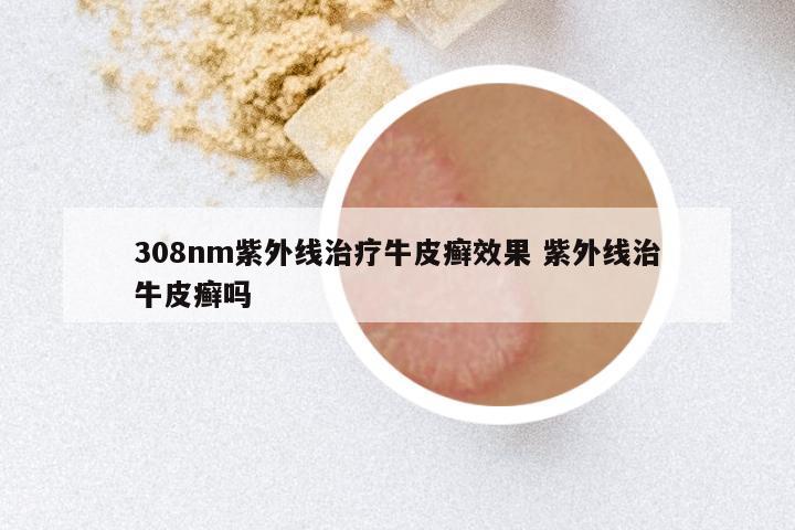 308nm紫外线治疗牛皮癣效果 紫外线治牛皮癣吗