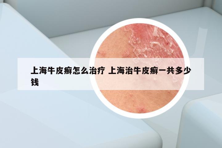 上海牛皮癣怎么治疗 上海治牛皮癣一共多少钱