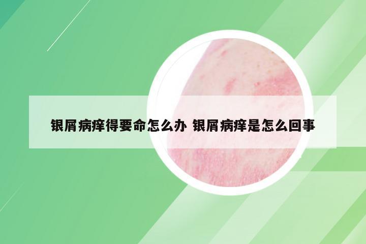 银屑病痒得要命怎么办 银屑病痒是怎么回事