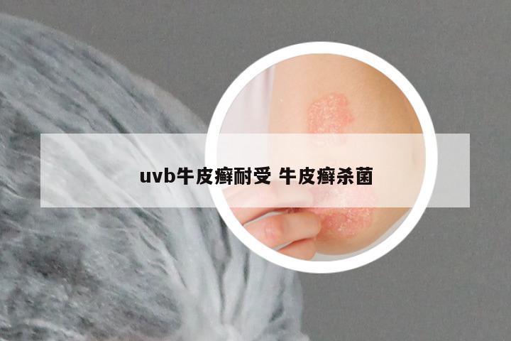 uvb牛皮癣耐受 牛皮癣杀菌