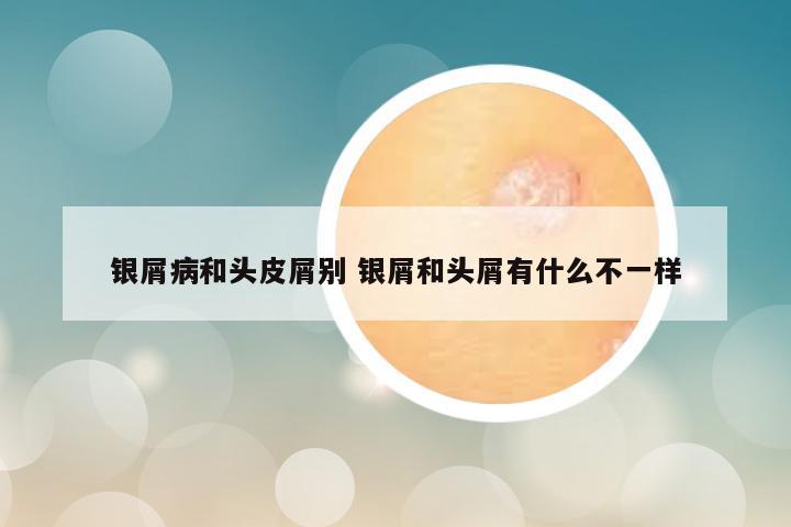 银屑病和头皮屑别 银屑和头屑有什么不一样