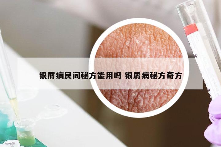 银屑病民间秘方能用吗 银屑病秘方奇方