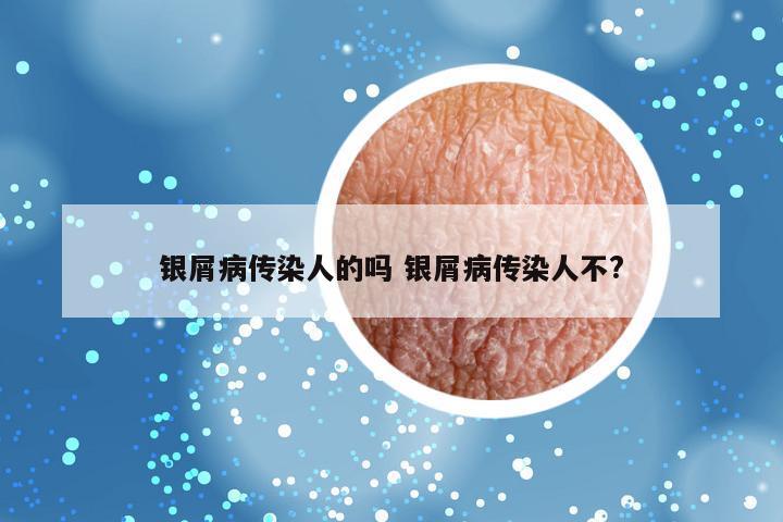 银屑病传染人的吗 银屑病传染人不?