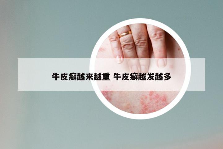 牛皮癣越来越重 牛皮癣越发越多