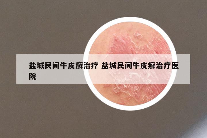 盐城民间牛皮癣治疗 盐城民间牛皮癣治疗医院