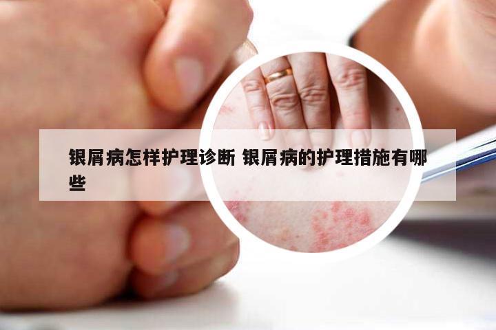 银屑病怎样护理诊断 银屑病的护理措施有哪些