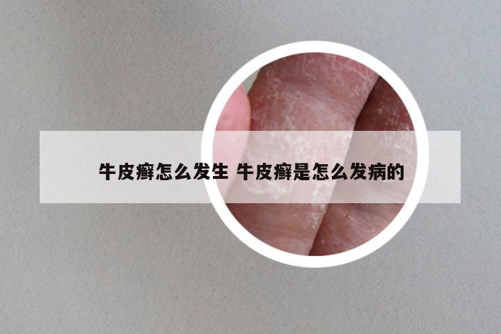 牛皮癣怎么发生 牛皮癣是怎么发病的