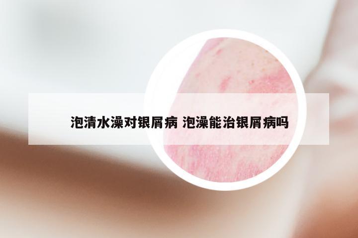 泡清水澡对银屑病 泡澡能治银屑病吗