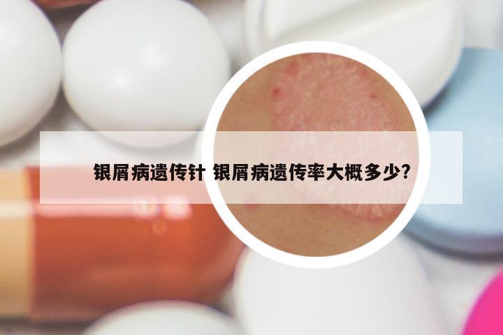 银屑病遗传针 银屑病遗传率大概多少?