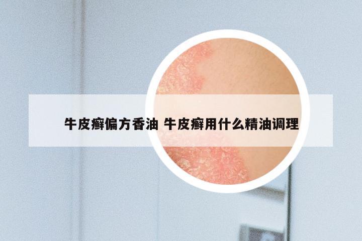 牛皮癣偏方香油 牛皮癣用什么精油调理