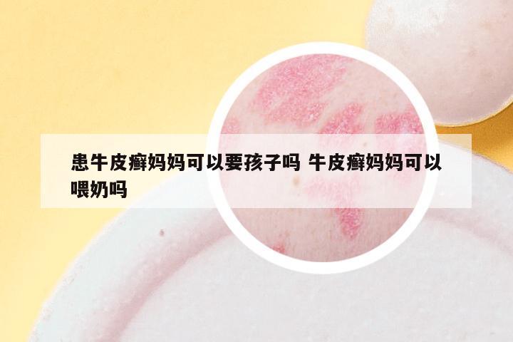 患牛皮癣妈妈可以要孩子吗 牛皮癣妈妈可以喂奶吗
