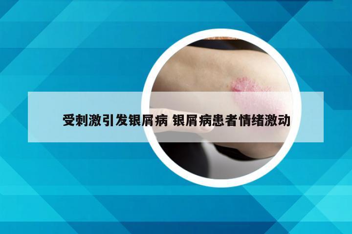 受刺激引发银屑病 银屑病患者情绪激动