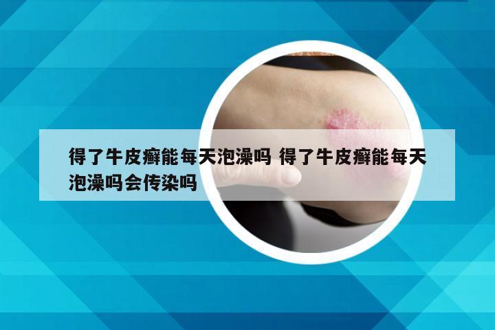 得了牛皮癣能每天泡澡吗 得了牛皮癣能每天泡澡吗会传染吗