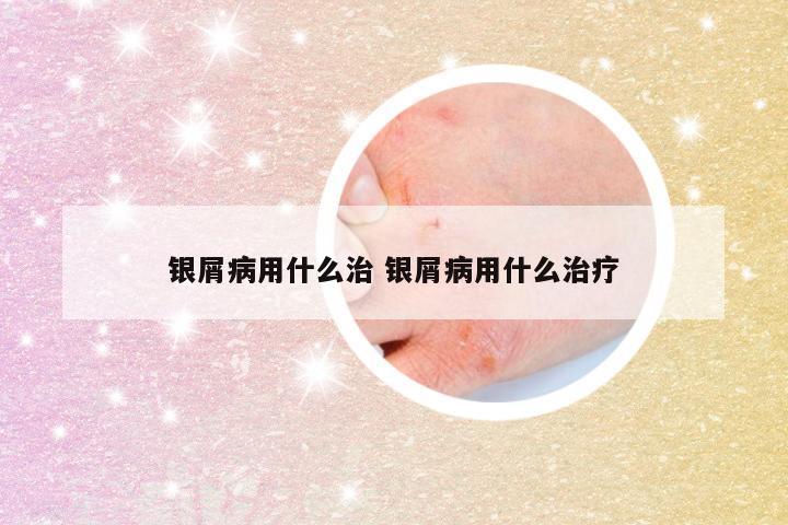 银屑病用什么治 银屑病用什么治疗