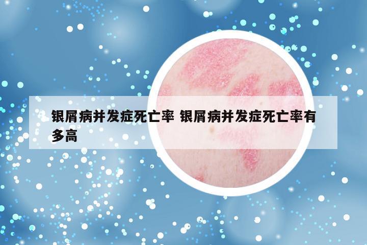 银屑病并发症死亡率 银屑病并发症死亡率有多高
