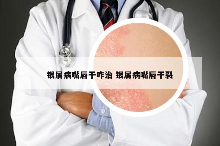 银屑病嘴唇干咋治 银屑病嘴唇干裂