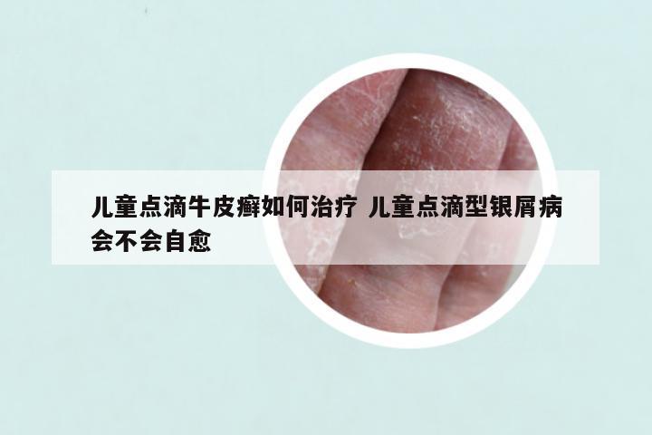 儿童点滴牛皮癣如何治疗 儿童点滴型银屑病会不会自愈