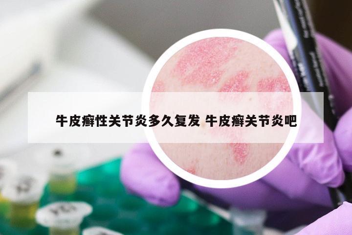 牛皮癣性关节炎多久复发 牛皮癣关节炎吧