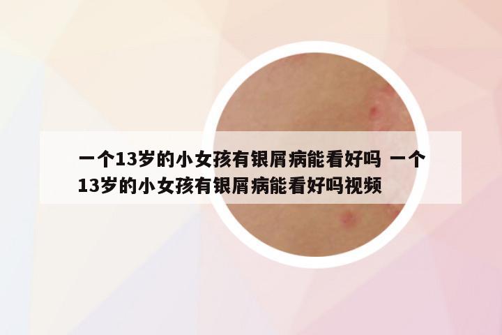 一个13岁的小女孩有银屑病能看好吗 一个13岁的小女孩有银屑病能看好吗视频