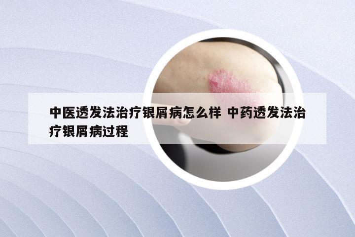 中医透发法治疗银屑病怎么样 中药透发法治疗银屑病过程