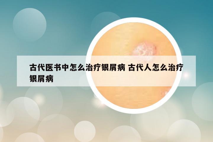 古代医书中怎么治疗银屑病 古代人怎么治疗银屑病
