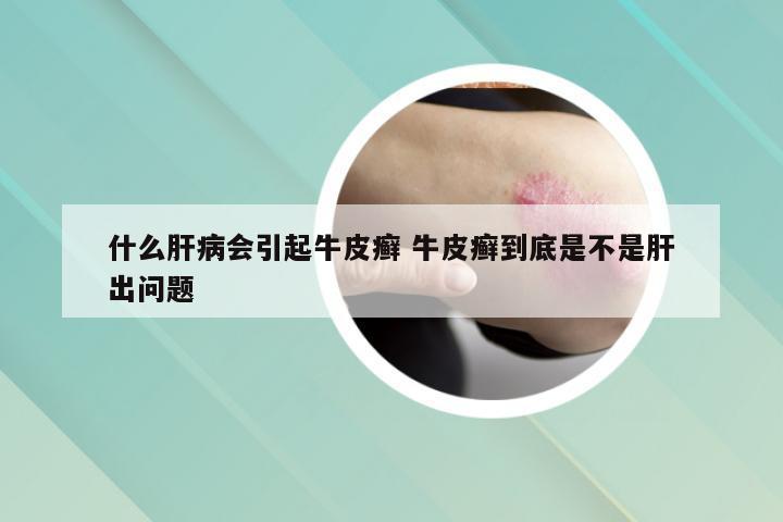 什么肝病会引起牛皮癣 牛皮癣到底是不是肝出问题