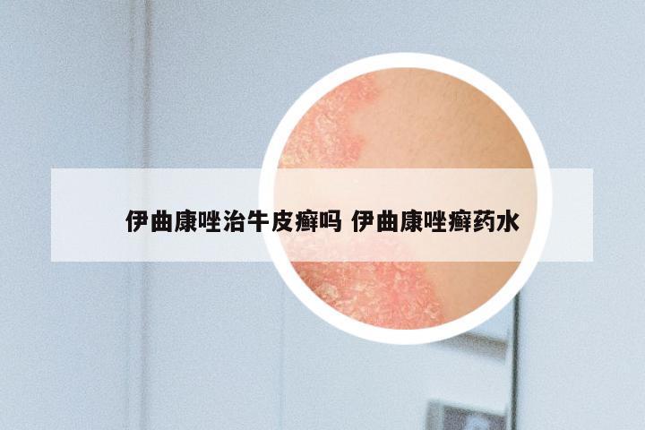 伊曲康唑治牛皮癣吗 伊曲康唑癣药水