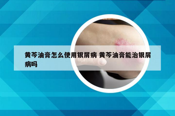 黄芩油膏怎么使用银屑病 黄芩油膏能治银屑病吗