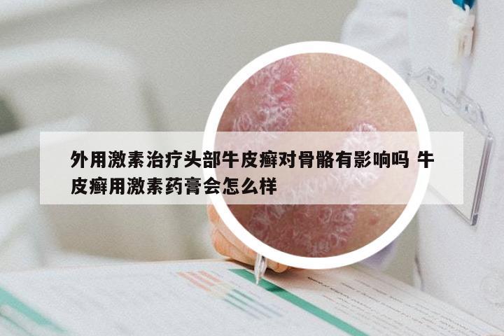外用激素治疗头部牛皮癣对骨骼有影响吗 牛皮癣用激素药膏会怎么样