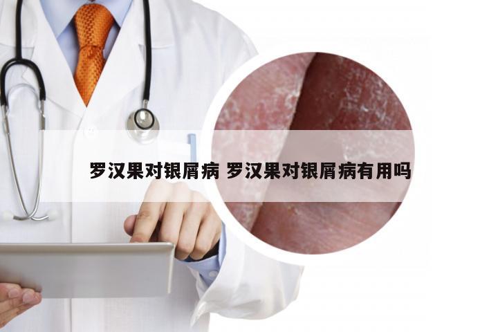 罗汉果对银屑病 罗汉果对银屑病有用吗