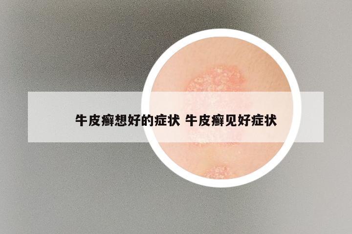 牛皮癣想好的症状 牛皮癣见好症状