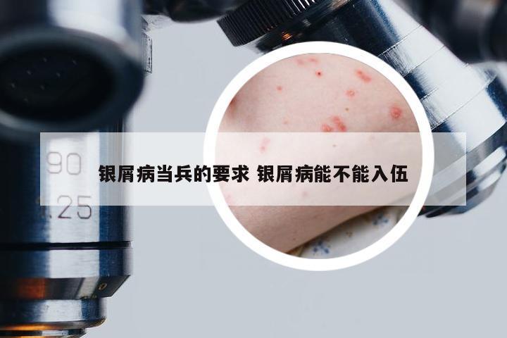 银屑病当兵的要求 银屑病能不能入伍